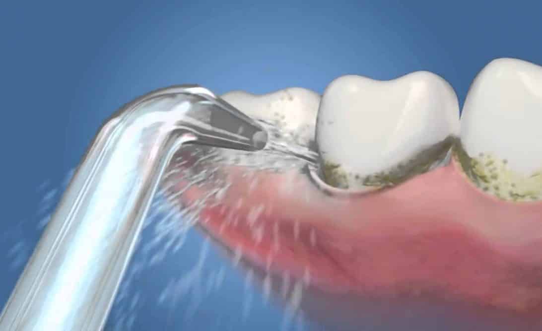 Can water flossers damage gums?