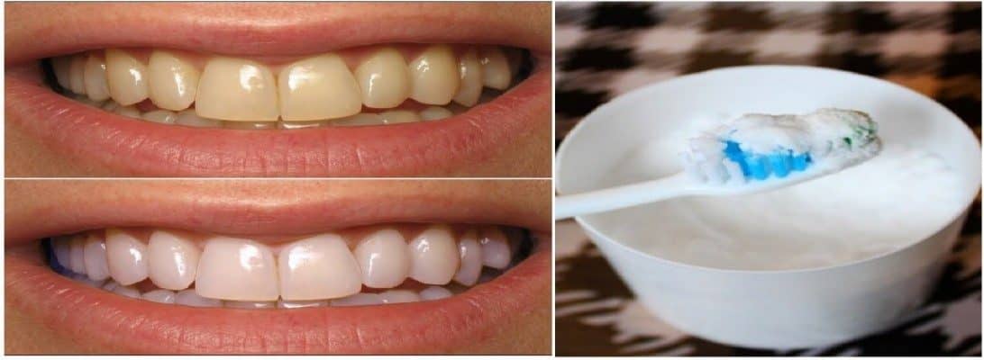 Is baking soda good for whitening teeth